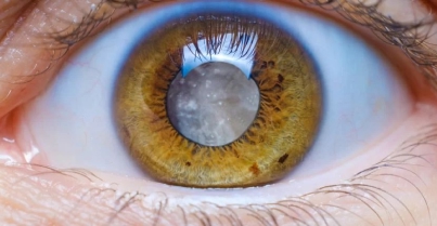 Cirurgia de catarata