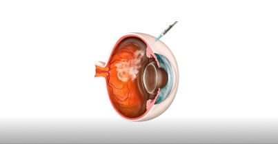 Injeções intravítreas de antiangiogênicos