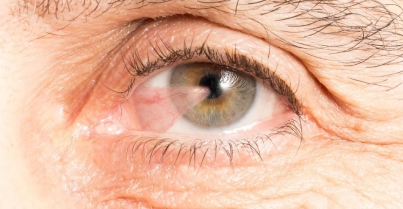 Cirurgia de pterígio